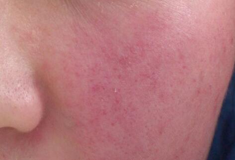 如何拯救你的敏感??？廣西南寧美容培訓(xùn)叫你正確方法