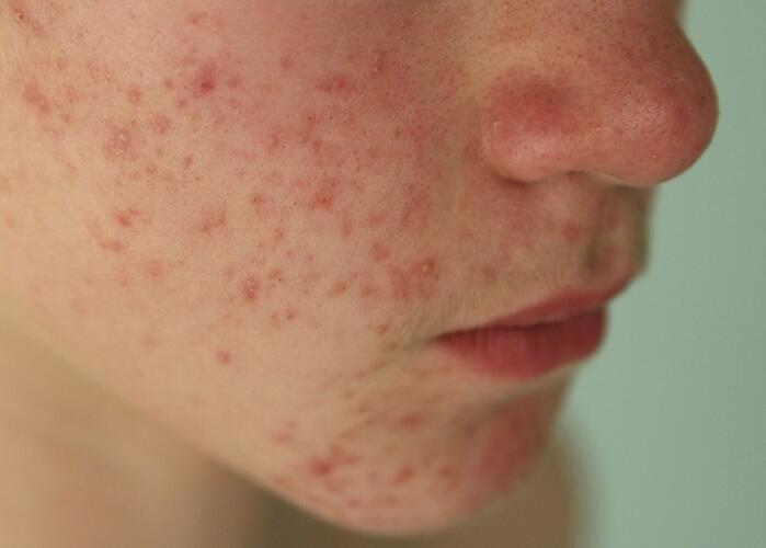 粉刺閉口應(yīng)該如何處理？