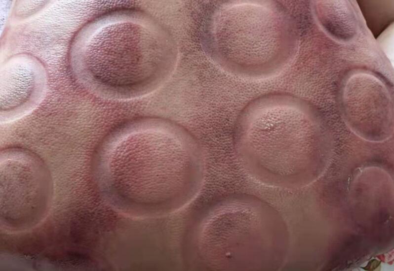 拔火罐有什么用？廣西美容職業(yè)培訓(xùn)學(xué)校演示給你看