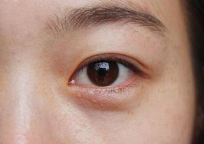 黑眼圈的種類(lèi)有哪些？廣西美容培訓(xùn)教你保養(yǎng)