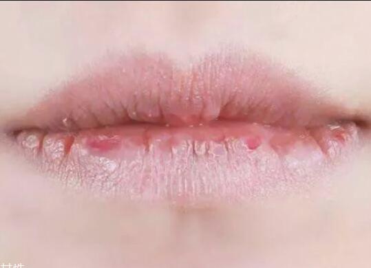 紋唇后嘴巴干燥怎么辦？南寧教紋繡的學(xué)校幫你解決