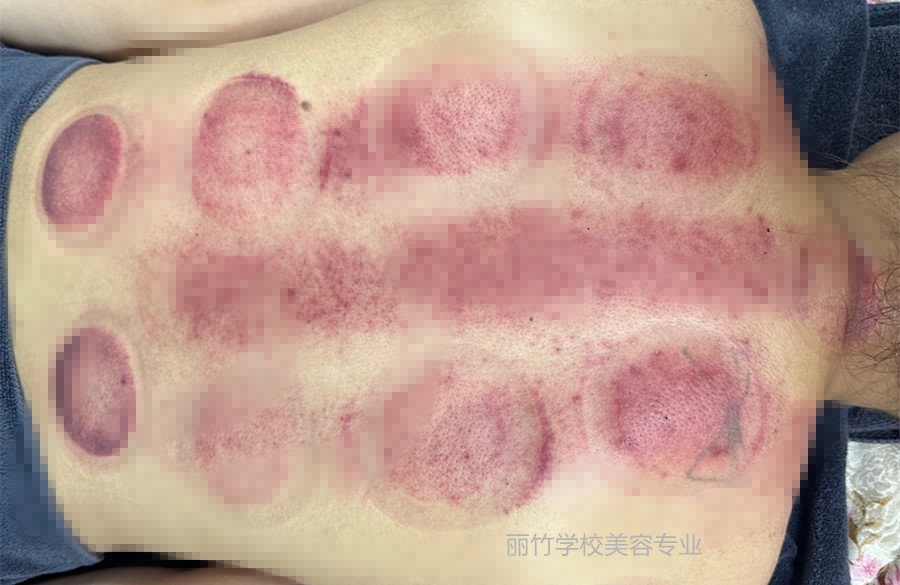 拔火罐的顏色代表什么？南寧美容美體專業(yè)實(shí)訓(xùn)