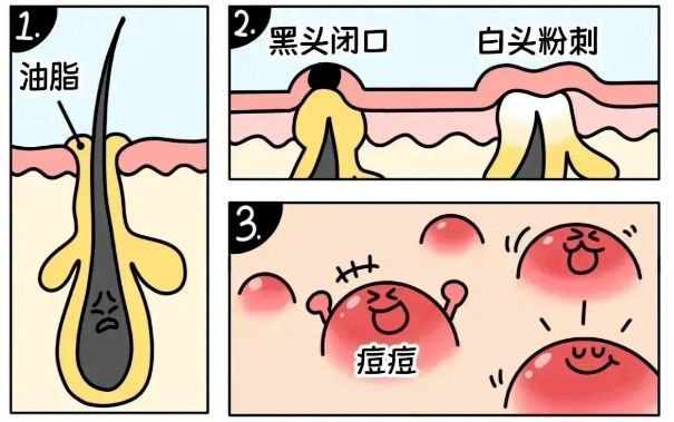 不同部位閉口形成的原因，南寧美容護膚學校解答