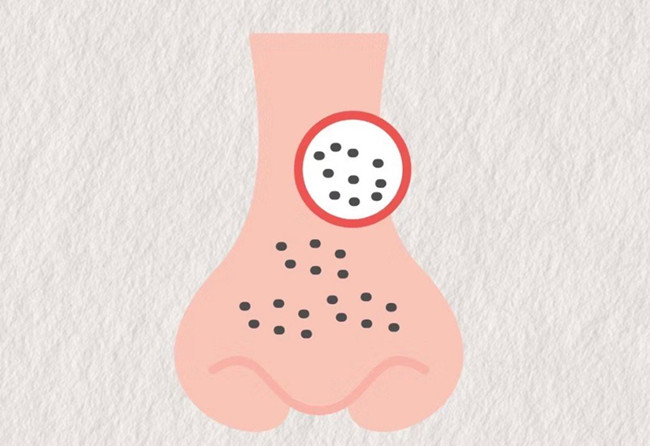 廣西皮膚管理師：面對嚴(yán)重的黑頭應(yīng)該怎么辦？